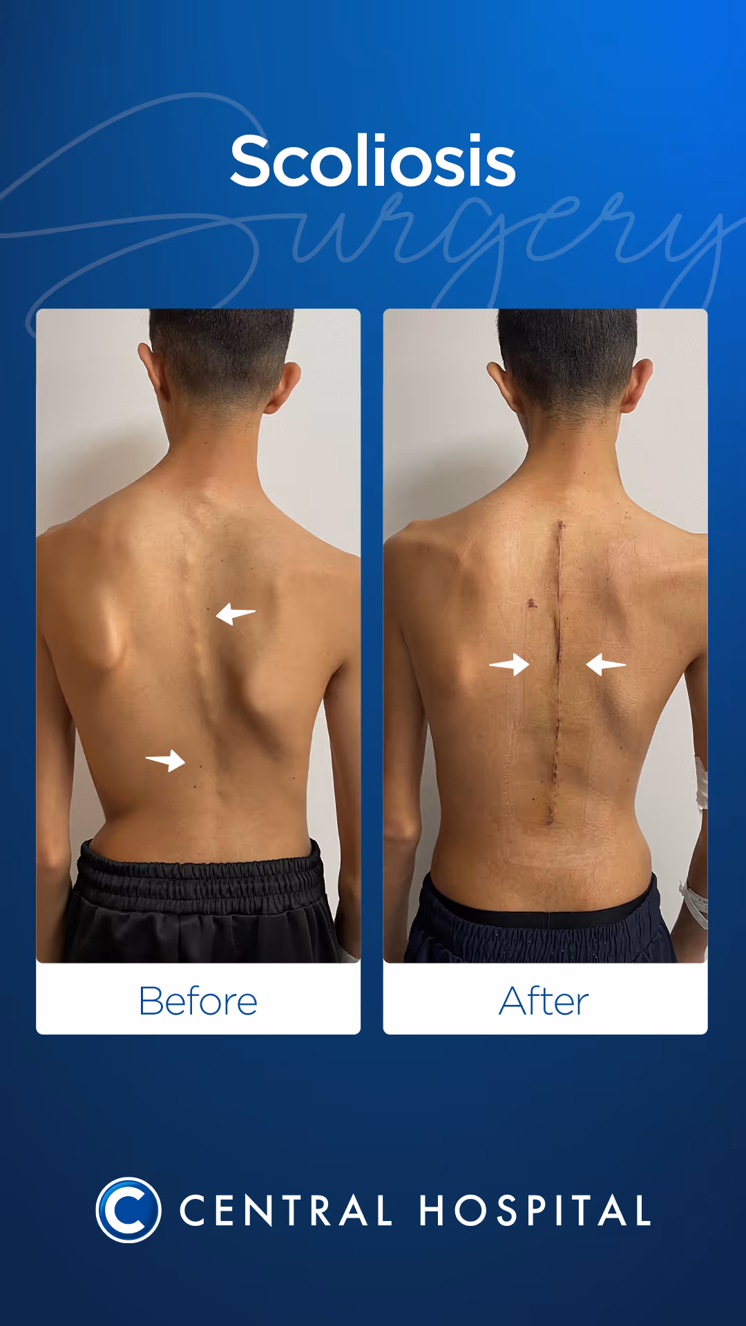 Skolyoz & Kifoz Cerrahisi 2