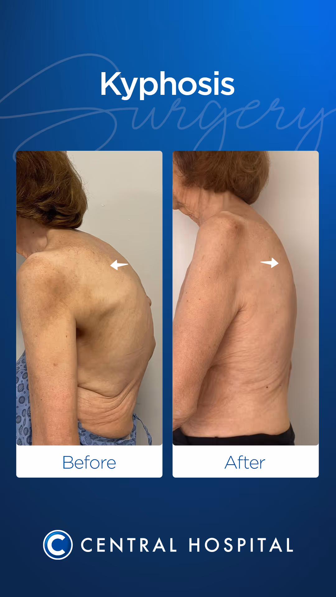 Skolyoz & Kifoz Cerrahisi 3