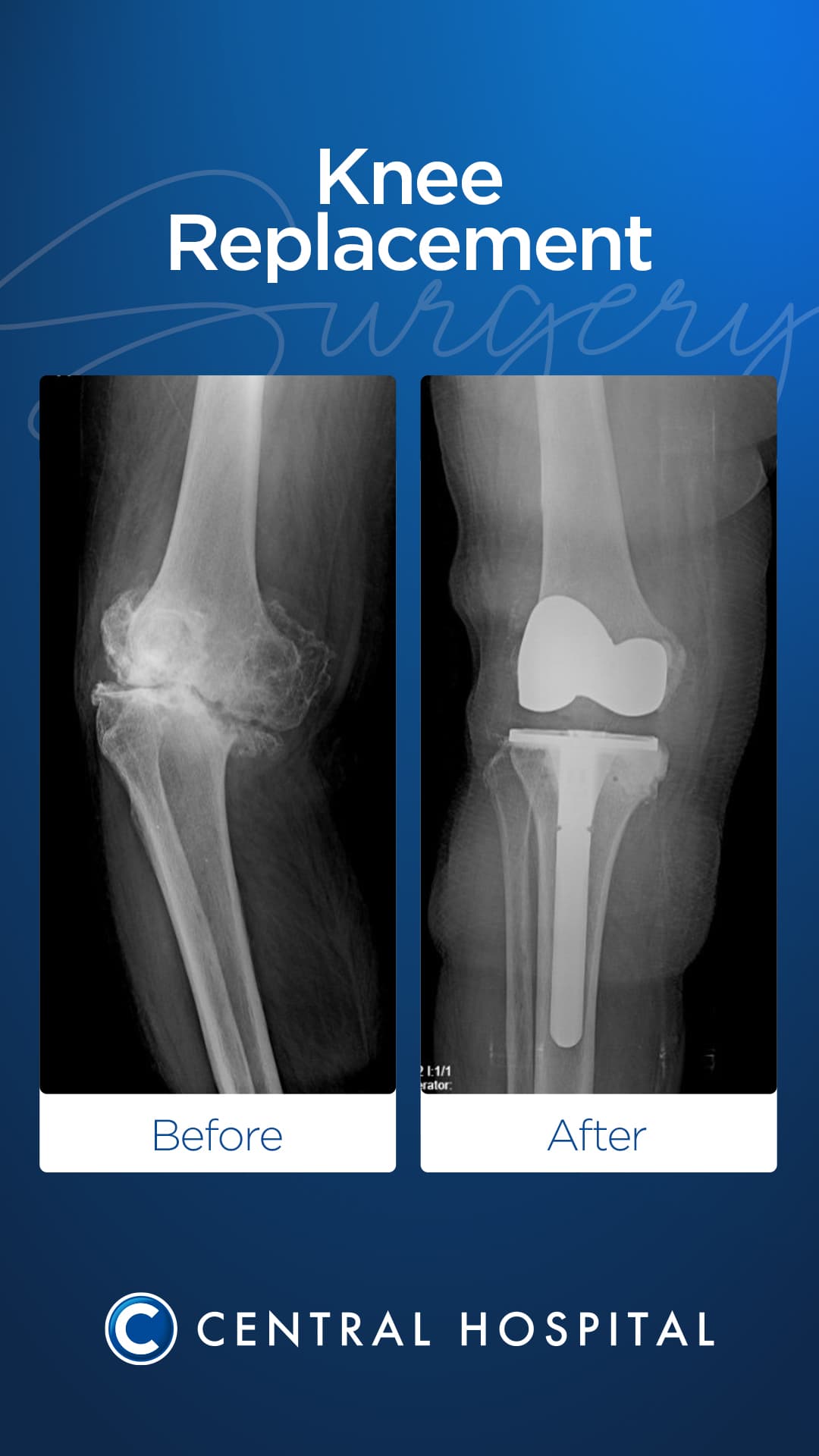 Diz & Kalça Protezi 1
